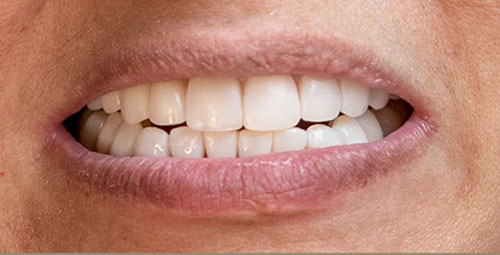 Smile Design Patient sandra sapon After