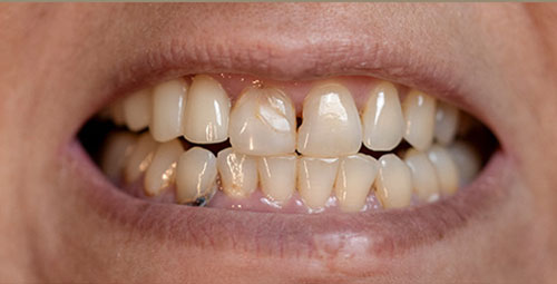 Smile Design Patient sandra sapon Before