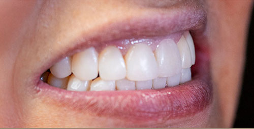 Smile Design Patient sandra sapon After