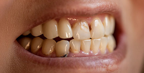 Smile Design Patient sandra sapon After