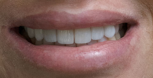 Smile Design Patient veronica aibar After