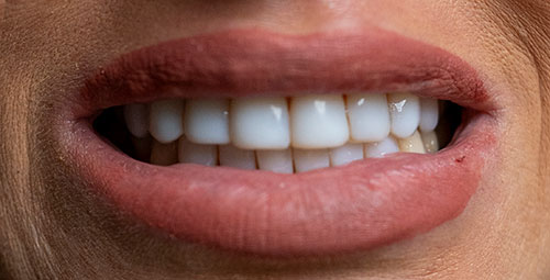 Smile Design Patient veronica aibar Before