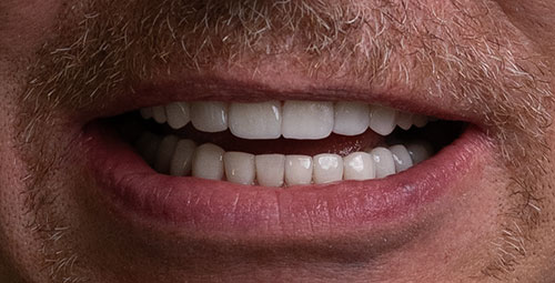 Smile Design Patient will After
