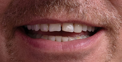 Smile Design Patient will Before