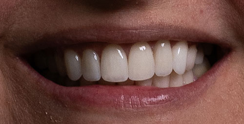 Smile Design Patient yasney After