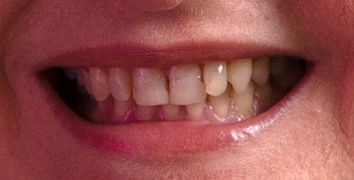 Smile Design Patient yasney Before