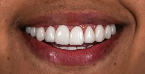 Smile Design Yereny Lopez After