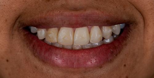 Smile Design Yereny Lopez Before