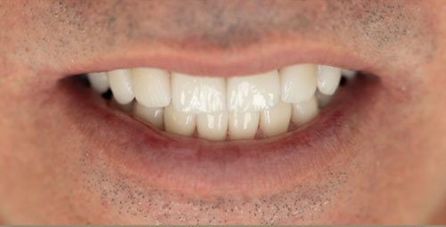Smile Design Patient yosviel blanco After