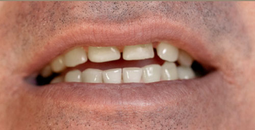 Smile Design Patient yosviel blanco Before