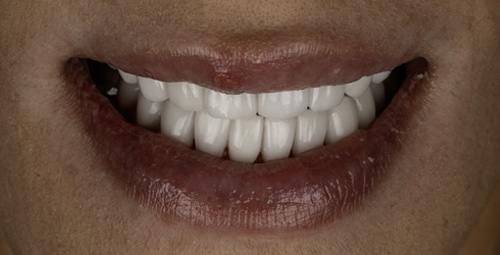Smile Design Jessica Gomez After