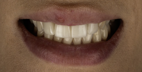Smile Design Jessica Gomez Before