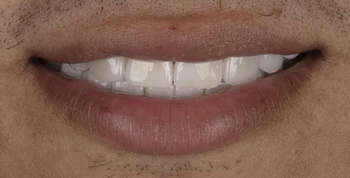 Smile Design johm amoroso After