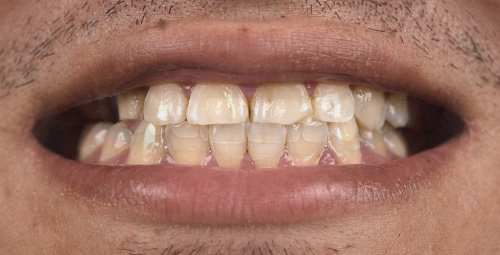 Smile Design johm amoroso Before