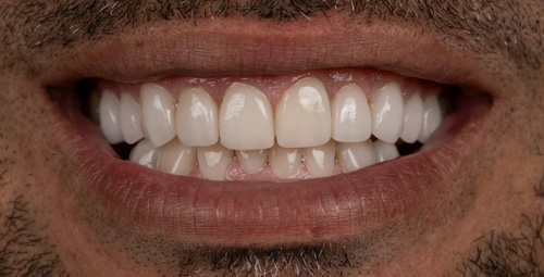 Smile Design Jose Lara After