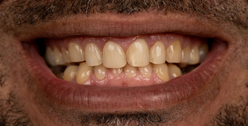 Smile Design Jose Lara Before