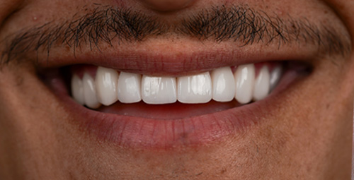 Smile Design juan After