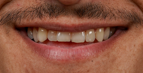Smile Design juan Before