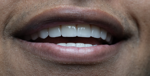 Smile Design La Crisstine After