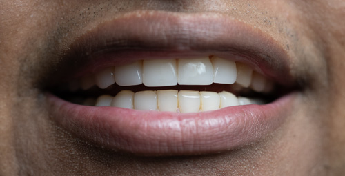 Smile Design La Crisstine Before