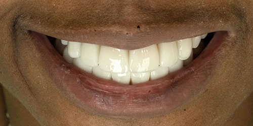 Smile Design Patient Latara Barnes After