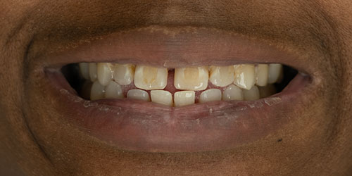 Smile Design Patient Latara Barnes Before