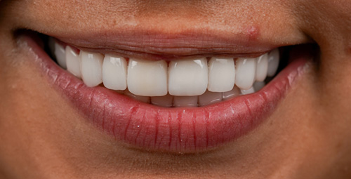 Smile Design Magda After