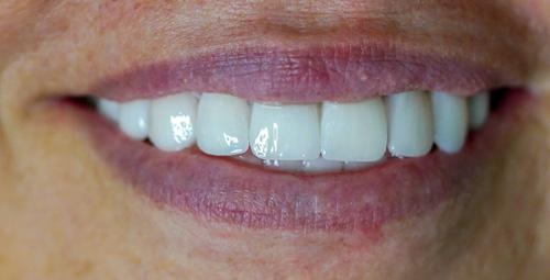 Smile Design Millami After