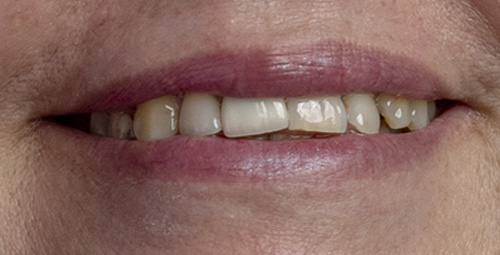 Smile Design Millami Before