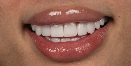 Smile Design Patrick Albaram After