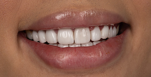 Smile Design Patrick Albaram Before