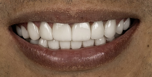 Smile Design sergio andres After