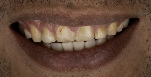 Smile Design sergio andres Before
