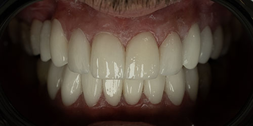 Smile Design Patient victor After