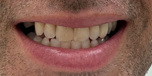 Smile Design Patient victor Before