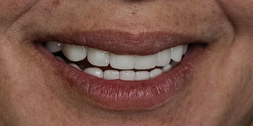 woman after smile transformation at Aria Smile Design