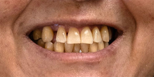 woman before smile transformation at Aria Smile Design