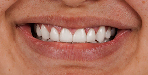 Smile Design zayira After