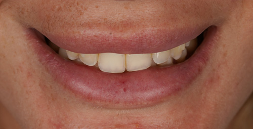 Smile Design zayira Before