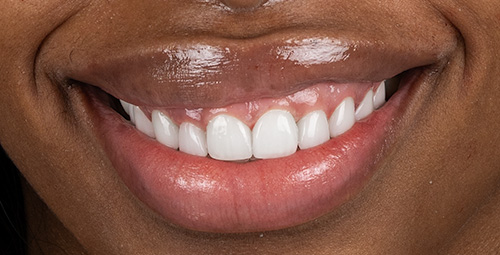 Smile Design Tamiya Peterson After