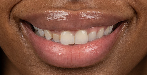 Smile Design Tamiya Peterson Before