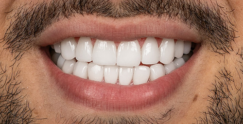 Smile Design Victor Pujano After