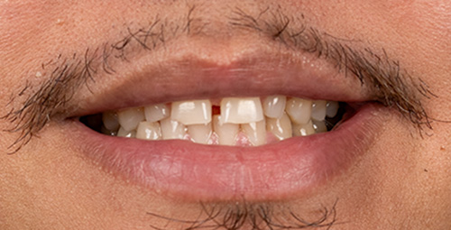 Smile Design Wilmer Luna Before