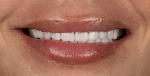 Smile Design Xiomy Ballesteros After