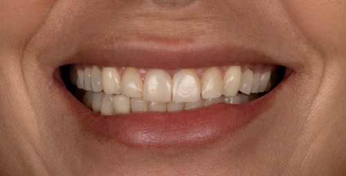 Smile Design Xiomy Ballesteros Before
