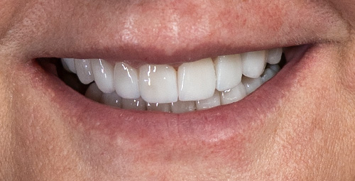 Smile Design yania After