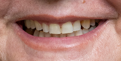 Smile Design yania Before