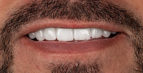 Smile Design Yasel Pimienta After