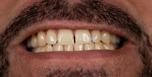 Smile Design Yasel Pimienta Before