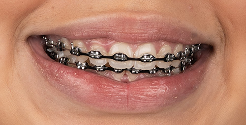 Smile Design Yuleyka Cruz Before